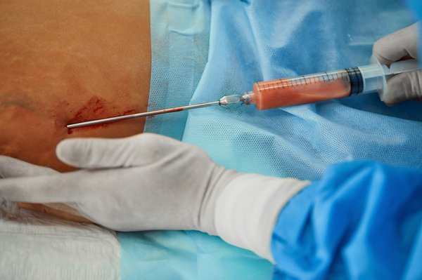 Tout savoir sur la liposuccion: guide complet et conseils